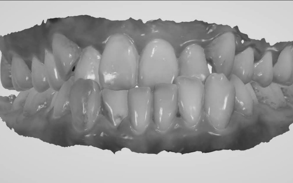 360度數位口腔掃瞄 檢查洗牙初體驗
